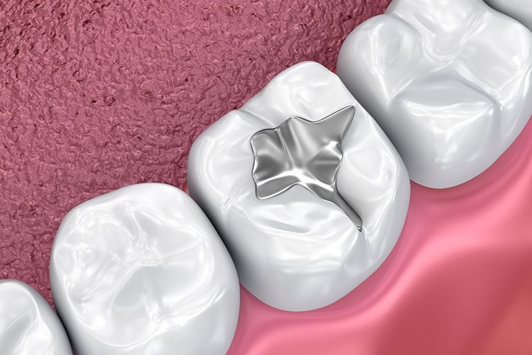 Dental fillings treatment at Best Smilles