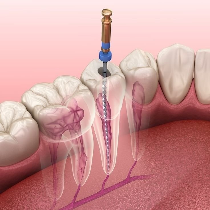 Root canal treatment at Best Smilles