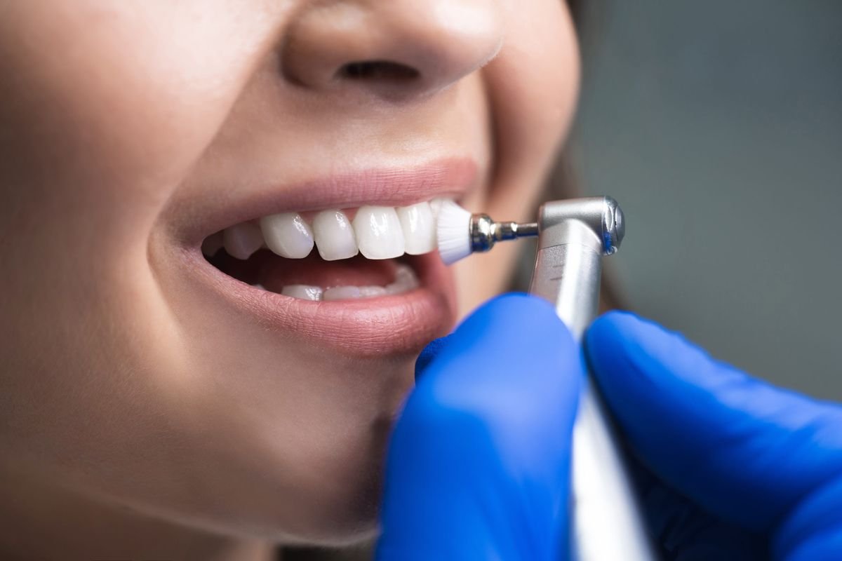 Dental cleaning and scaling at Best Smilles