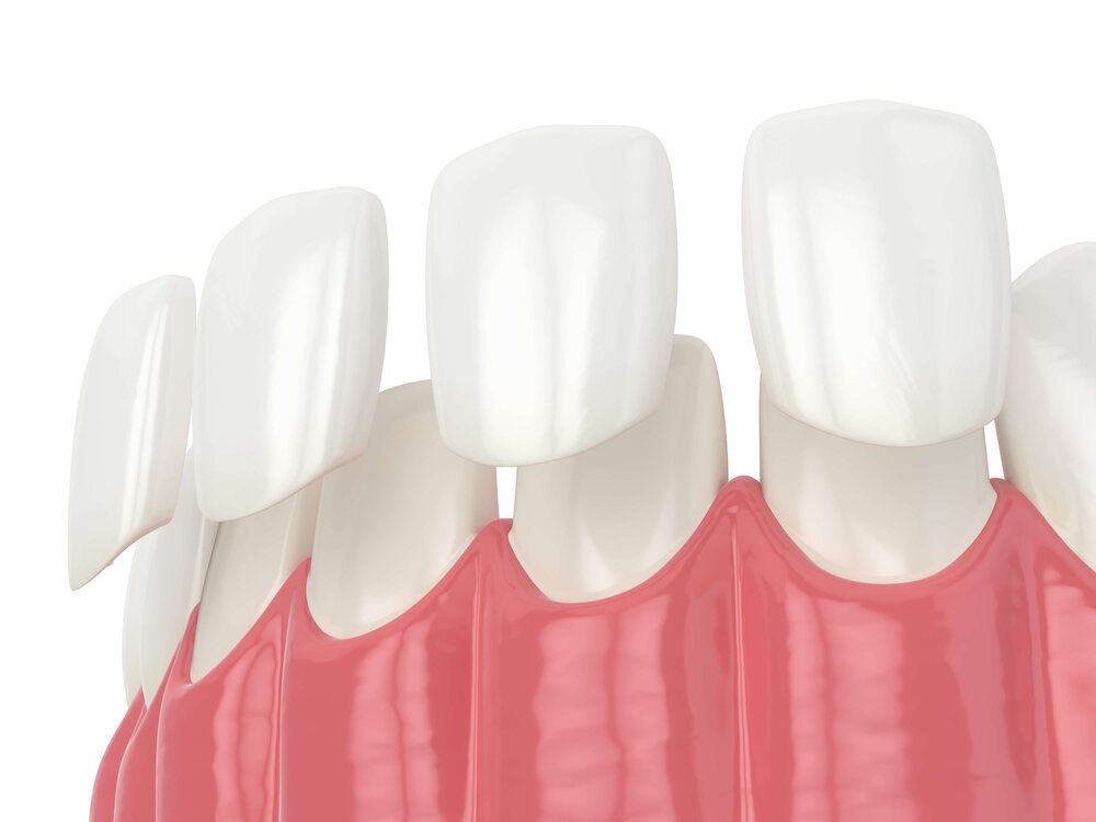 Porcelain veneers treatment at Best Smilles