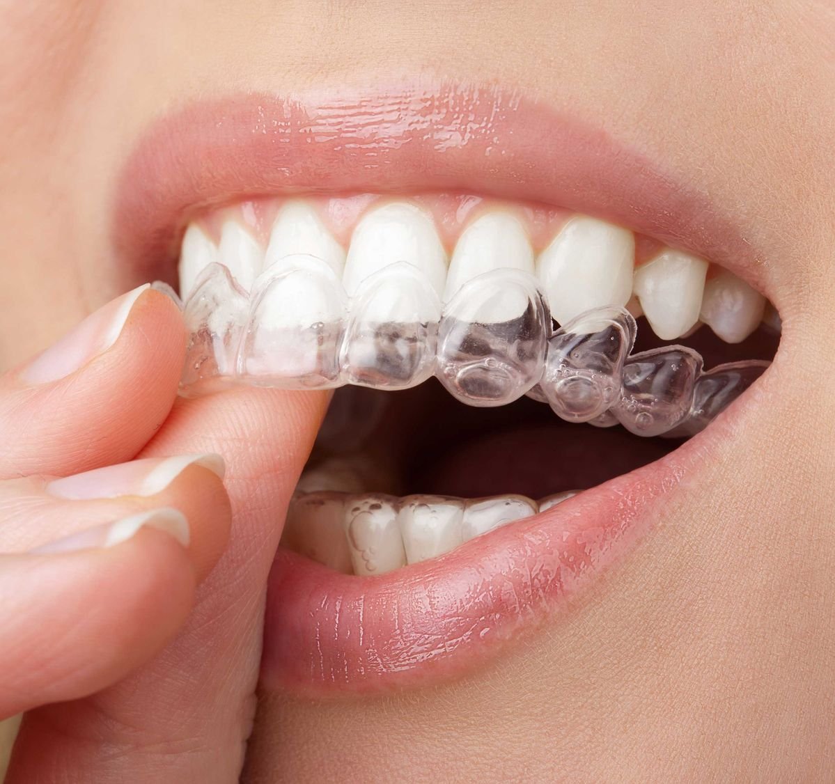Clear aligners treatment at Best Smilles